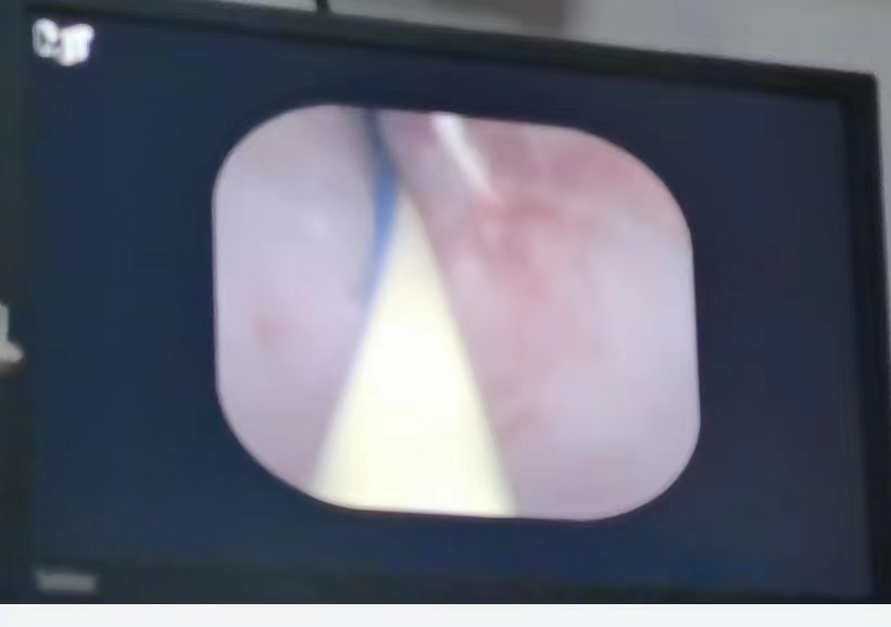 斑马导丝是治疗什么的【新技术】阑尾炎也可以不开刀：全市首例内镜逆行性阑尾炎治疗术（ERAT）+阑尾子镜+阑尾支架置入术_https://www.jmylbn.com_新闻资讯_第7张