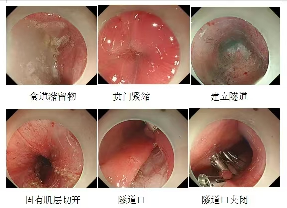 消化道动力检测怎么做【新技术】我院消化内科开展食道动力检测_https://www.jmylbn.com_新闻资讯_第4张