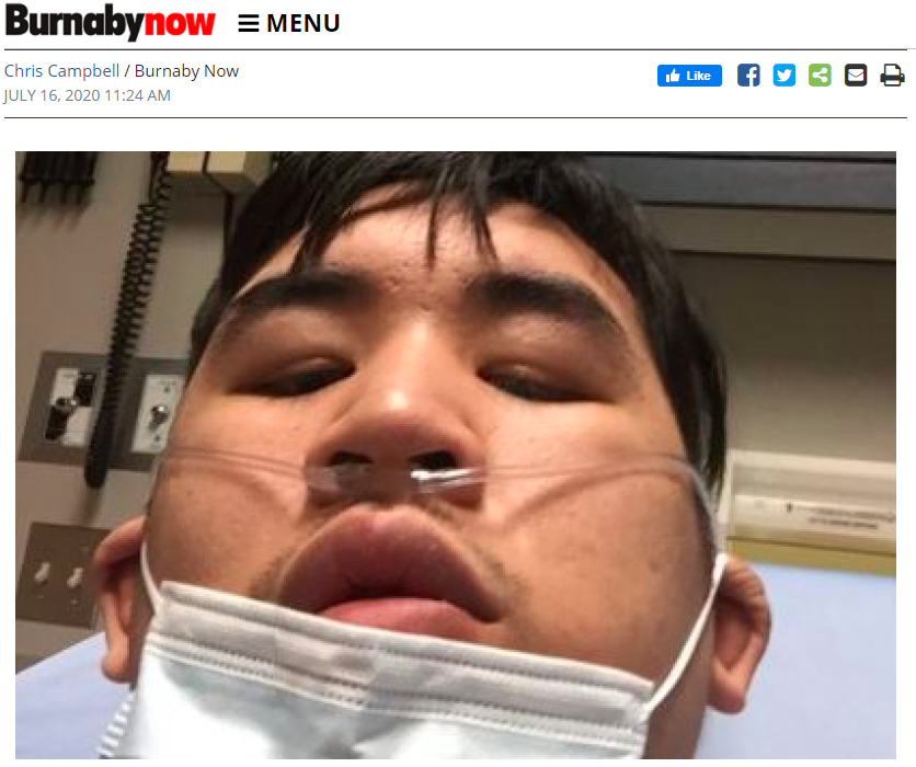 26岁华裔小哥离奇感染，5个月后还经常疲劳头痛，无法完全恢复（组图） - 3