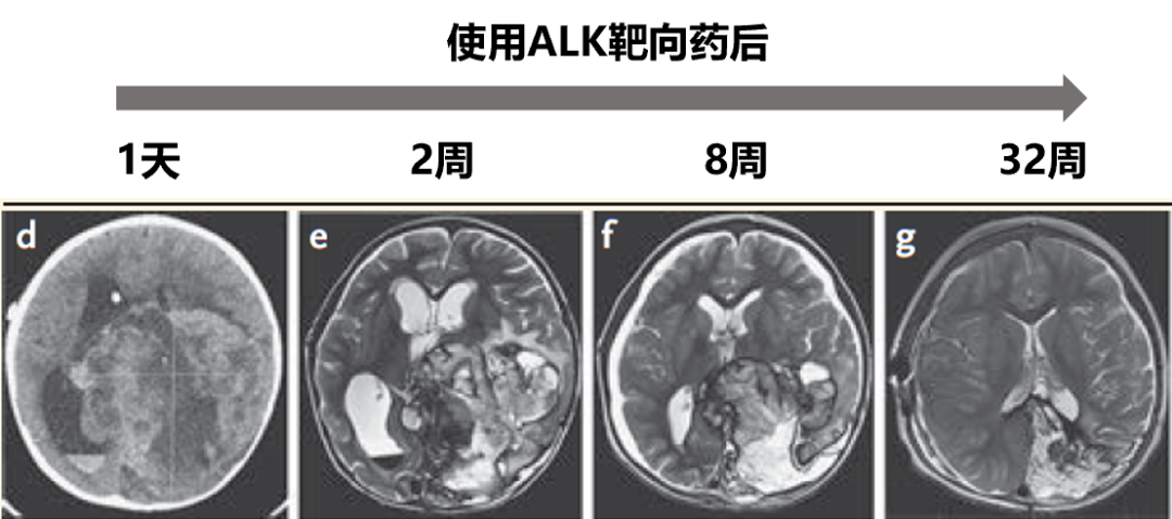 夹不住拖鞋查出脑瘤