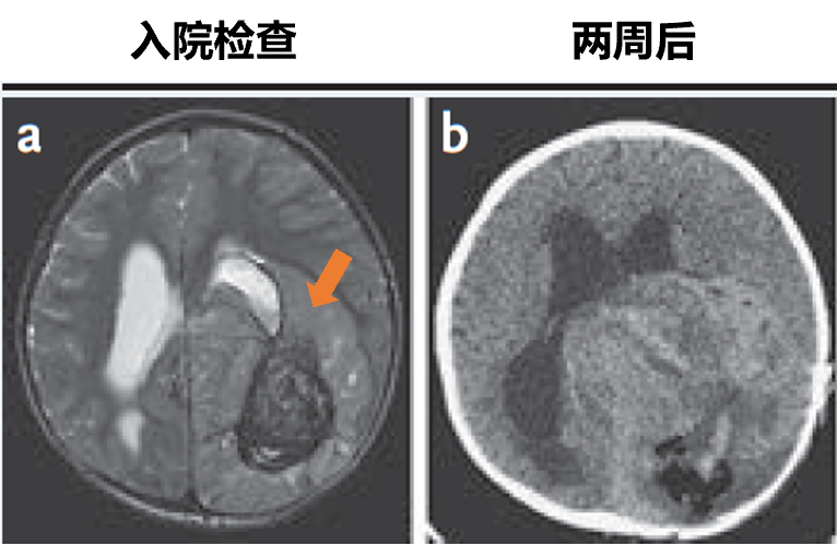 夹不住拖鞋查出脑瘤