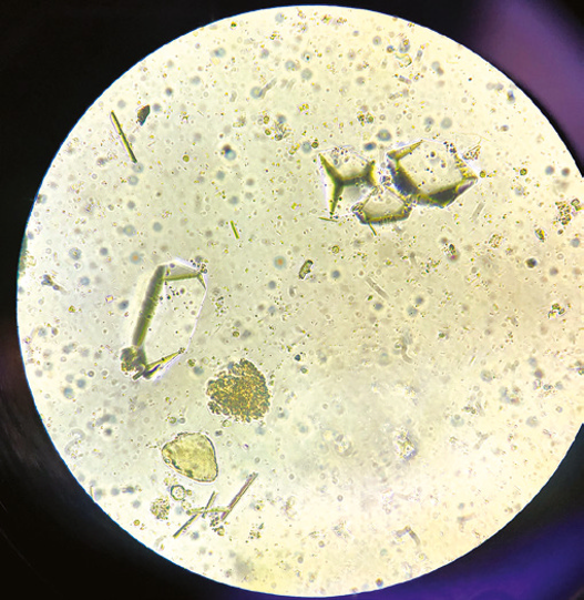 粪沉渣怎么取最新资料整理的尿检图谱：36张图片手把手教你辨认尿液中的鸟粪石结晶_https://www.jmylbn.com_新闻资讯_第33张