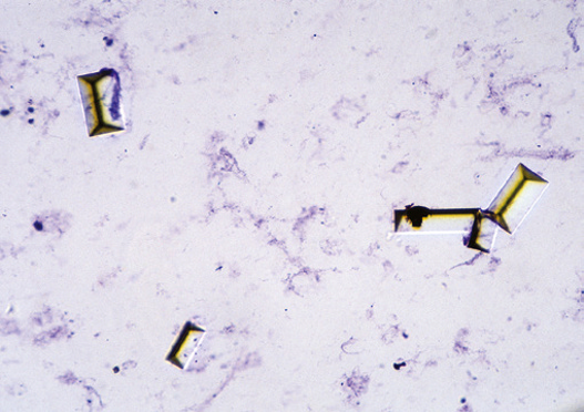 粪沉渣怎么取最新资料整理的尿检图谱：36张图片手把手教你辨认尿液中的鸟粪石结晶_https://www.jmylbn.com_新闻资讯_第11张