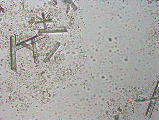 粪沉渣怎么取最新资料整理的尿检图谱：36张图片手把手教你辨认尿液中的鸟粪石结晶_https://www.jmylbn.com_新闻资讯_第35张