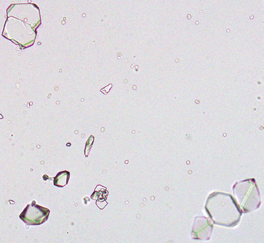粪沉渣怎么取最新资料整理的尿检图谱：36张图片手把手教你辨认尿液中的鸟粪石结晶_https://www.jmylbn.com_新闻资讯_第30张