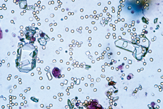 粪沉渣怎么取最新资料整理的尿检图谱：36张图片手把手教你辨认尿液中的鸟粪石结晶_https://www.jmylbn.com_新闻资讯_第15张