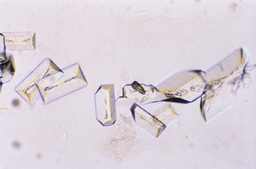 粪沉渣怎么取最新资料整理的尿检图谱：36张图片手把手教你辨认尿液中的鸟粪石结晶_https://www.jmylbn.com_新闻资讯_第23张