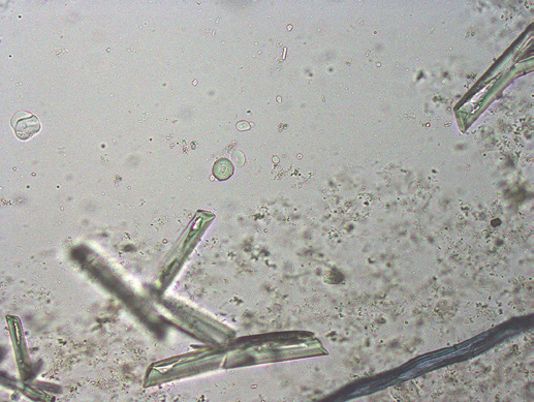 粪沉渣怎么取最新资料整理的尿检图谱：36张图片手把手教你辨认尿液中的鸟粪石结晶_https://www.jmylbn.com_新闻资讯_第34张