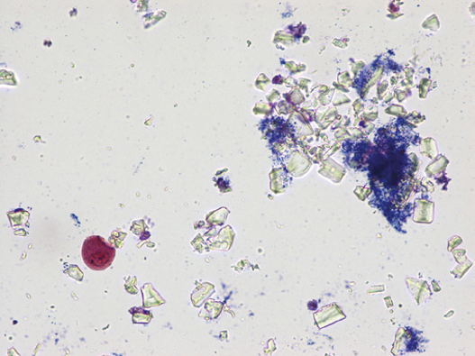 粪沉渣怎么取最新资料整理的尿检图谱：36张图片手把手教你辨认尿液中的鸟粪石结晶_https://www.jmylbn.com_新闻资讯_第25张