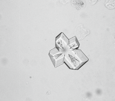粪沉渣怎么取最新资料整理的尿检图谱：36张图片手把手教你辨认尿液中的鸟粪石结晶_https://www.jmylbn.com_新闻资讯_第6张