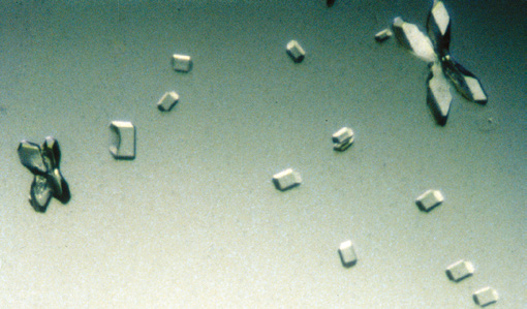 粪沉渣怎么取最新资料整理的尿检图谱：36张图片手把手教你辨认尿液中的鸟粪石结晶_https://www.jmylbn.com_新闻资讯_第26张