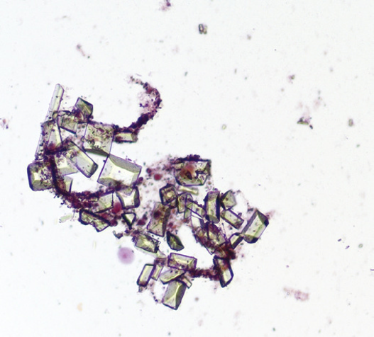 粪沉渣怎么取最新资料整理的尿检图谱：36张图片手把手教你辨认尿液中的鸟粪石结晶_https://www.jmylbn.com_新闻资讯_第21张