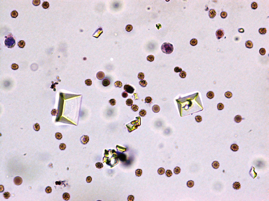 粪沉渣怎么取最新资料整理的尿检图谱：36张图片手把手教你辨认尿液中的鸟粪石结晶_https://www.jmylbn.com_新闻资讯_第13张