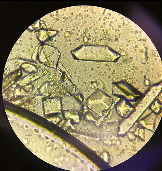 粪沉渣怎么取最新资料整理的尿检图谱：36张图片手把手教你辨认尿液中的鸟粪石结晶_https://www.jmylbn.com_新闻资讯_第16张