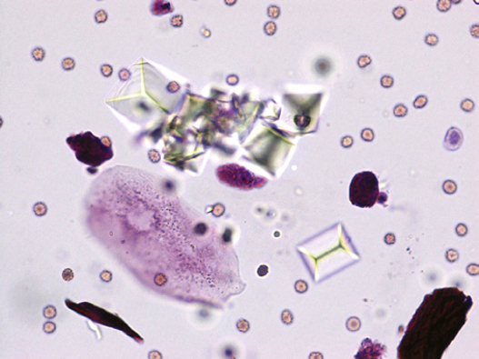 粪沉渣怎么取最新资料整理的尿检图谱：36张图片手把手教你辨认尿液中的鸟粪石结晶_https://www.jmylbn.com_新闻资讯_第14张