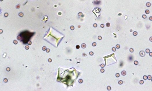 粪沉渣怎么取最新资料整理的尿检图谱：36张图片手把手教你辨认尿液中的鸟粪石结晶_https://www.jmylbn.com_新闻资讯_第12张