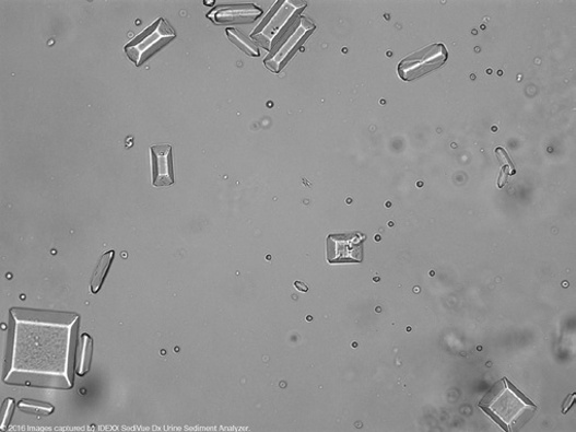 粪沉渣怎么取最新资料整理的尿检图谱：36张图片手把手教你辨认尿液中的鸟粪石结晶_https://www.jmylbn.com_新闻资讯_第20张