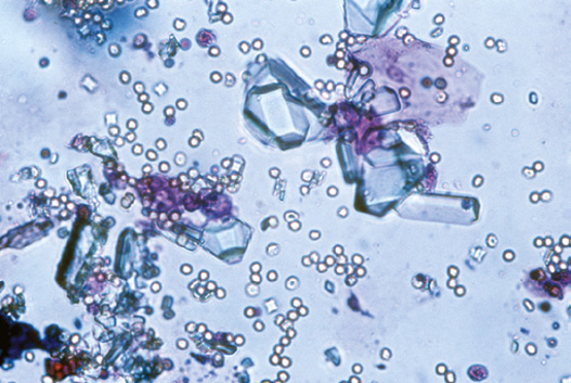 粪沉渣怎么取最新资料整理的尿检图谱：36张图片手把手教你辨认尿液中的鸟粪石结晶_https://www.jmylbn.com_新闻资讯_第22张