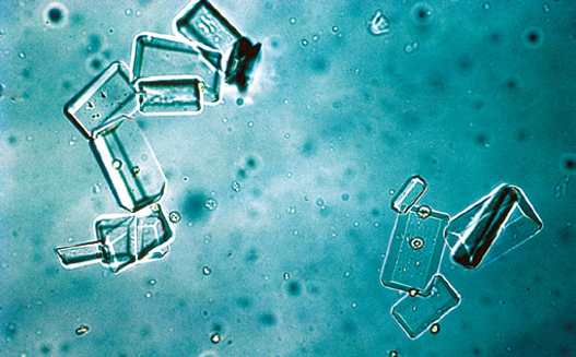 粪沉渣怎么取最新资料整理的尿检图谱：36张图片手把手教你辨认尿液中的鸟粪石结晶_https://www.jmylbn.com_新闻资讯_第3张