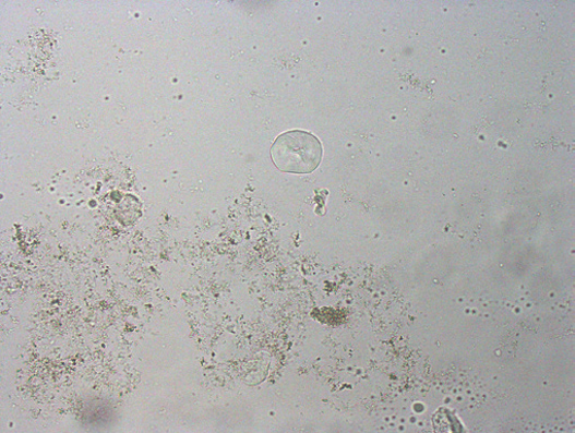 粪沉渣怎么取最新资料整理的尿检图谱：36张图片手把手教你辨认尿液中的鸟粪石结晶_https://www.jmylbn.com_新闻资讯_第32张