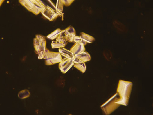 粪沉渣怎么取最新资料整理的尿检图谱：36张图片手把手教你辨认尿液中的鸟粪石结晶_https://www.jmylbn.com_新闻资讯_第27张