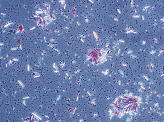 粪沉渣怎么取最新资料整理的尿检图谱：36张图片手把手教你辨认尿液中的鸟粪石结晶_https://www.jmylbn.com_新闻资讯_第29张