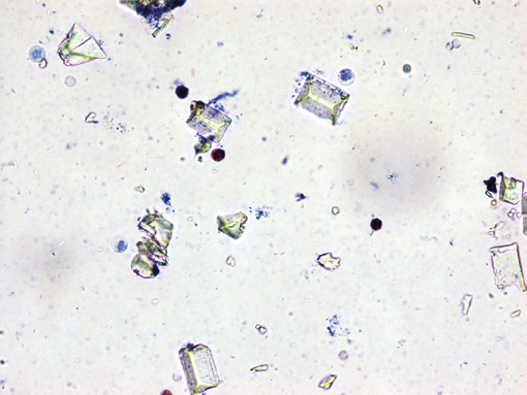 粪沉渣怎么取最新资料整理的尿检图谱：36张图片手把手教你辨认尿液中的鸟粪石结晶_https://www.jmylbn.com_新闻资讯_第19张