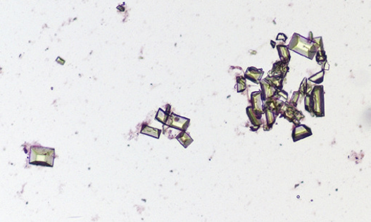 粪沉渣怎么取最新资料整理的尿检图谱：36张图片手把手教你辨认尿液中的鸟粪石结晶_https://www.jmylbn.com_新闻资讯_第24张