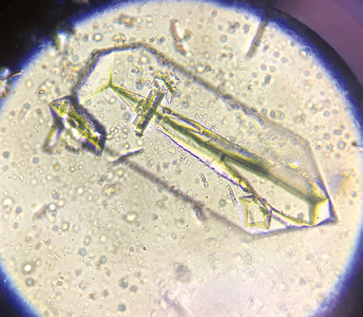 粪沉渣怎么取最新资料整理的尿检图谱：36张图片手把手教你辨认尿液中的鸟粪石结晶_https://www.jmylbn.com_新闻资讯_第17张