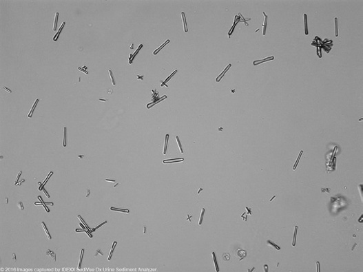 粪沉渣怎么取最新资料整理的尿检图谱：36张图片手把手教你辨认尿液中的鸟粪石结晶_https://www.jmylbn.com_新闻资讯_第31张