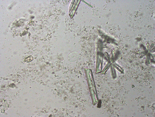 粪沉渣怎么取最新资料整理的尿检图谱：36张图片手把手教你辨认尿液中的鸟粪石结晶_https://www.jmylbn.com_新闻资讯_第36张