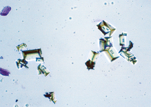 粪沉渣怎么取最新资料整理的尿检图谱：36张图片手把手教你辨认尿液中的鸟粪石结晶_https://www.jmylbn.com_新闻资讯_第18张