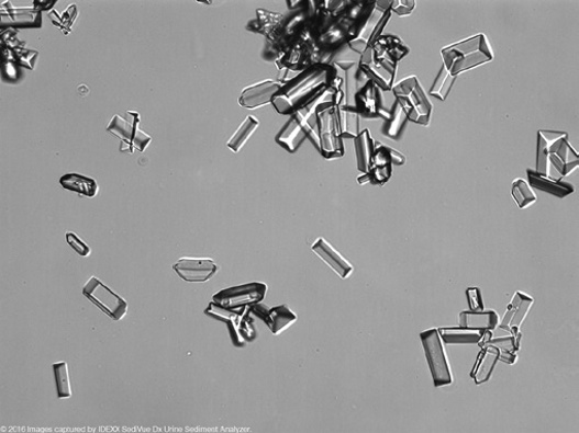 粪沉渣怎么取最新资料整理的尿检图谱：36张图片手把手教你辨认尿液中的鸟粪石结晶_https://www.jmylbn.com_新闻资讯_第9张