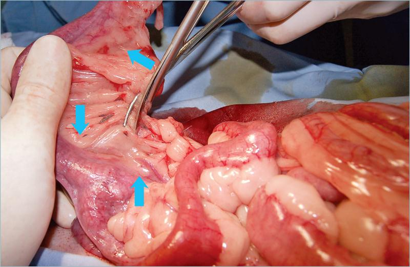 为什么要结扎血管外科实用技术图谱：23张图片详解卵巢子宫切除术的操作要点_https://www.jmylbn.com_新闻资讯_第15张