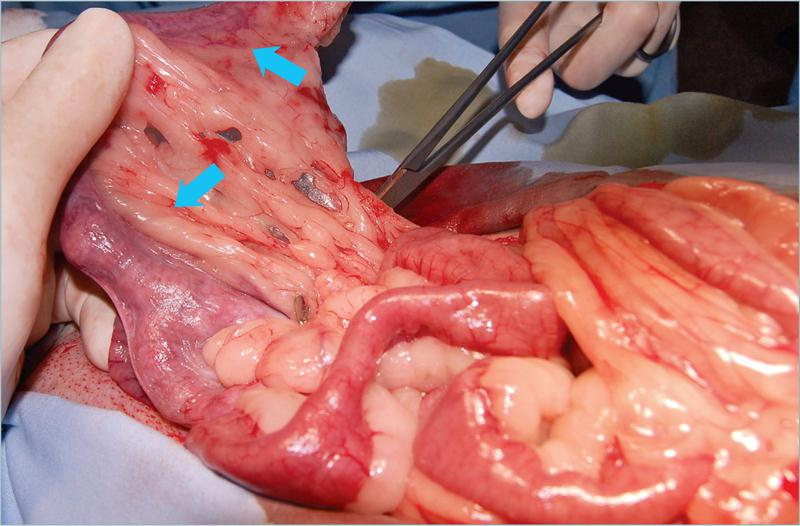 为什么要结扎血管外科实用技术图谱：23张图片详解卵巢子宫切除术的操作要点_https://www.jmylbn.com_新闻资讯_第14张
