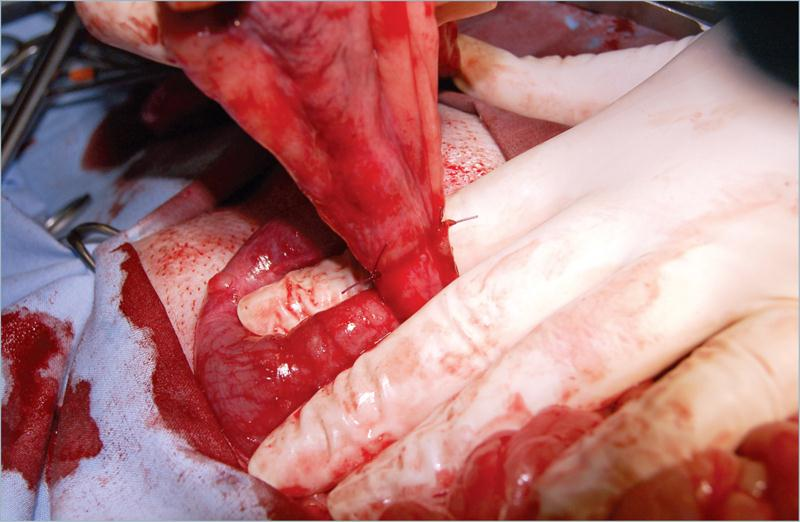 为什么要结扎血管外科实用技术图谱：23张图片详解卵巢子宫切除术的操作要点_https://www.jmylbn.com_新闻资讯_第18张