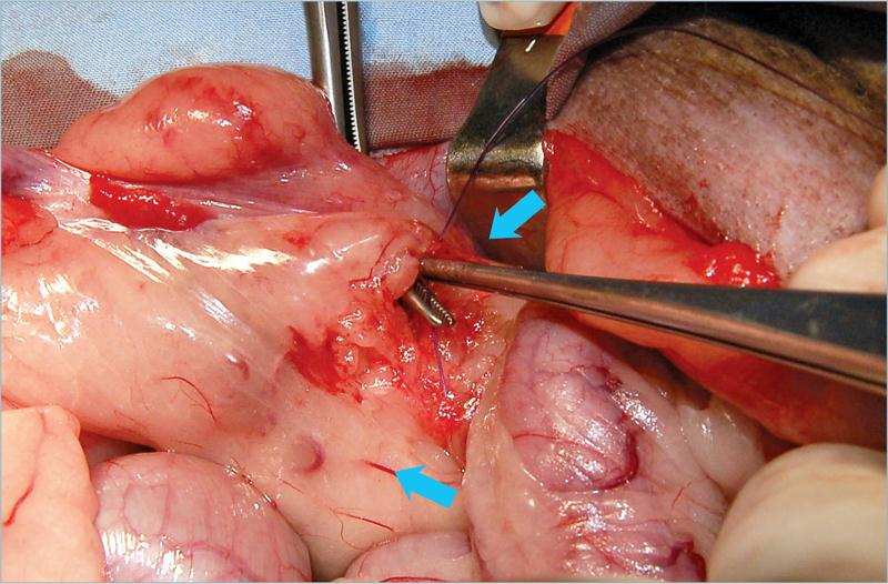 为什么要结扎血管外科实用技术图谱：23张图片详解卵巢子宫切除术的操作要点_https://www.jmylbn.com_新闻资讯_第8张