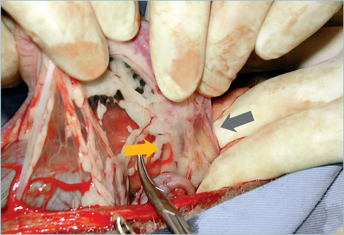 为什么要结扎血管外科实用技术图谱：23张图片详解卵巢子宫切除术的操作要点_https://www.jmylbn.com_新闻资讯_第7张