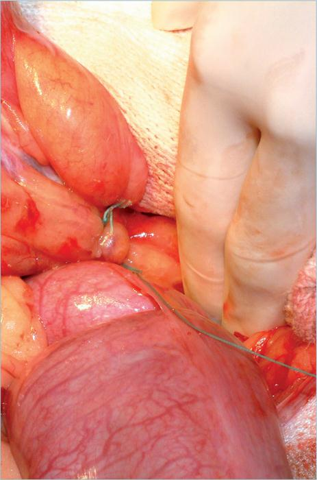 为什么要结扎血管外科实用技术图谱：23张图片详解卵巢子宫切除术的操作要点_https://www.jmylbn.com_新闻资讯_第5张