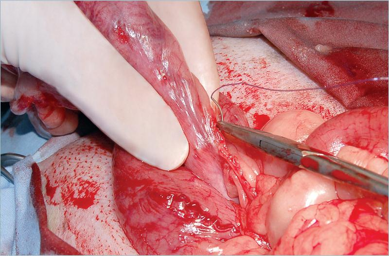 为什么要结扎血管外科实用技术图谱：23张图片详解卵巢子宫切除术的操作要点_https://www.jmylbn.com_新闻资讯_第17张