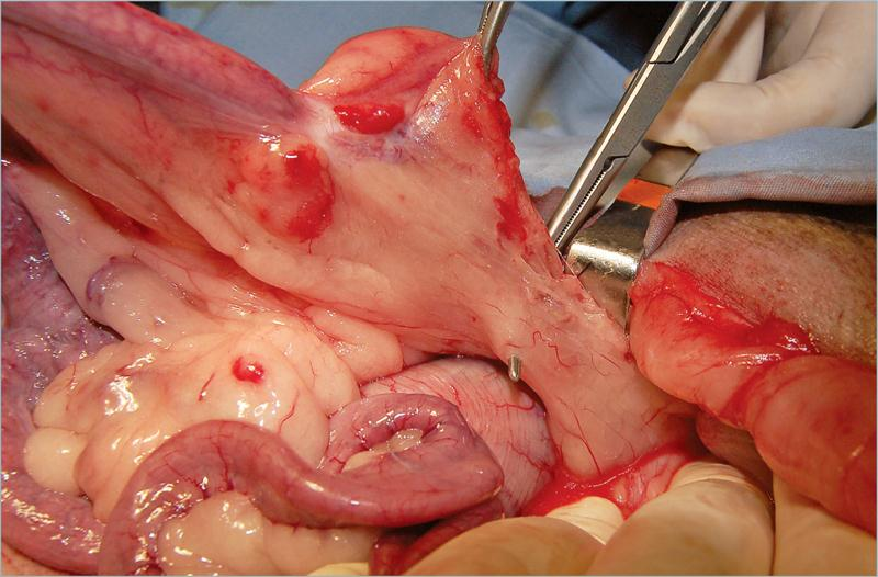 为什么要结扎血管外科实用技术图谱：23张图片详解卵巢子宫切除术的操作要点_https://www.jmylbn.com_新闻资讯_第10张