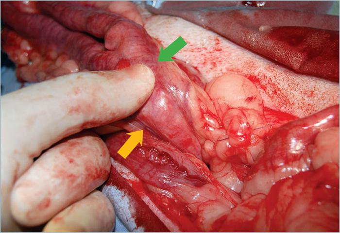 为什么要结扎血管外科实用技术图谱：23张图片详解卵巢子宫切除术的操作要点_https://www.jmylbn.com_新闻资讯_第16张