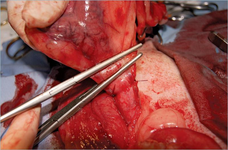 为什么要结扎血管外科实用技术图谱：23张图片详解卵巢子宫切除术的操作要点_https://www.jmylbn.com_新闻资讯_第19张