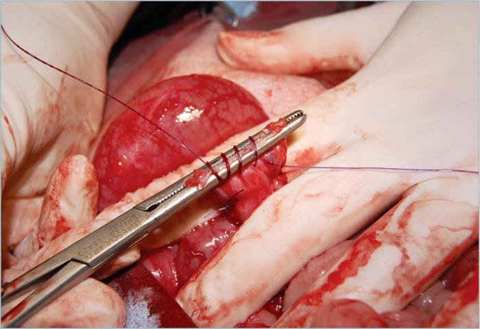 为什么要结扎血管外科实用技术图谱：23张图片详解卵巢子宫切除术的操作要点_https://www.jmylbn.com_新闻资讯_第22张