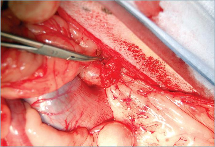 为什么要结扎血管外科实用技术图谱：23张图片详解卵巢子宫切除术的操作要点_https://www.jmylbn.com_新闻资讯_第13张