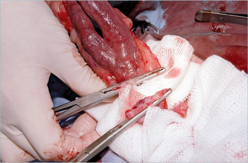 为什么要结扎血管外科实用技术图谱：23张图片详解卵巢子宫切除术的操作要点_https://www.jmylbn.com_新闻资讯_第20张