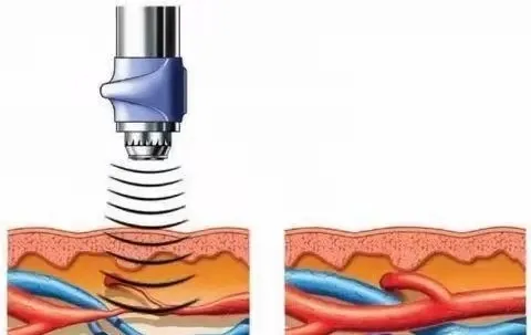 冲击波治疗效果怎么样冲击波疗法作用部位精准高效、方法简单治疗疼痛的首选方式！_https://www.jmylbn.com_新闻资讯_第1张