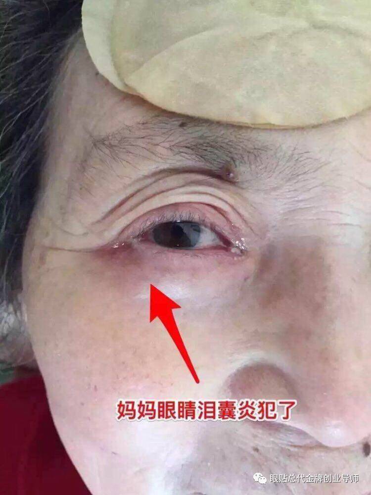 黄金视力眼贴使用案例反馈及分析汇总一