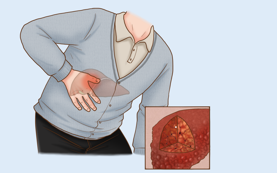 困扰两亿国人！年轻健壮的肝是怎么一步步坏掉的？