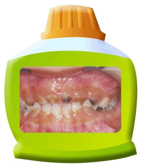 口腔百科丨蛀牙的战争：看你“氟”不“氟”